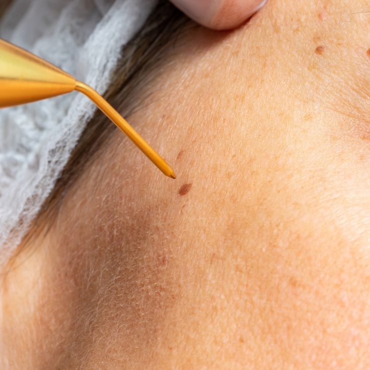 Remoción lunares y verrugas