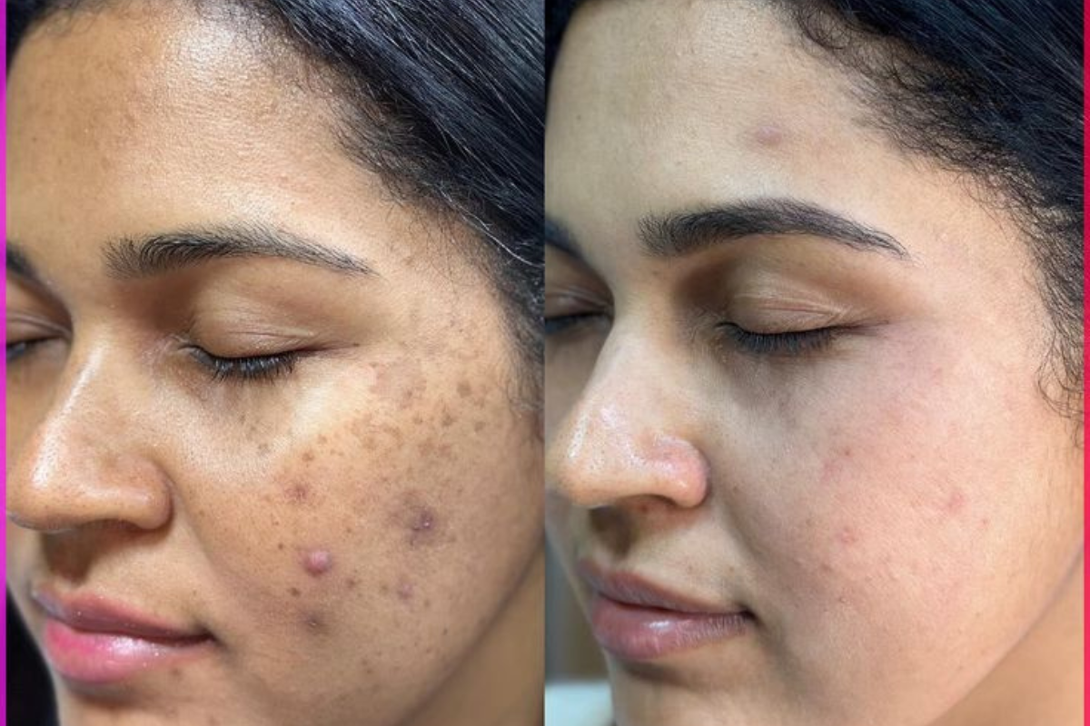 Dermaplaning en Ciudad de Panamá