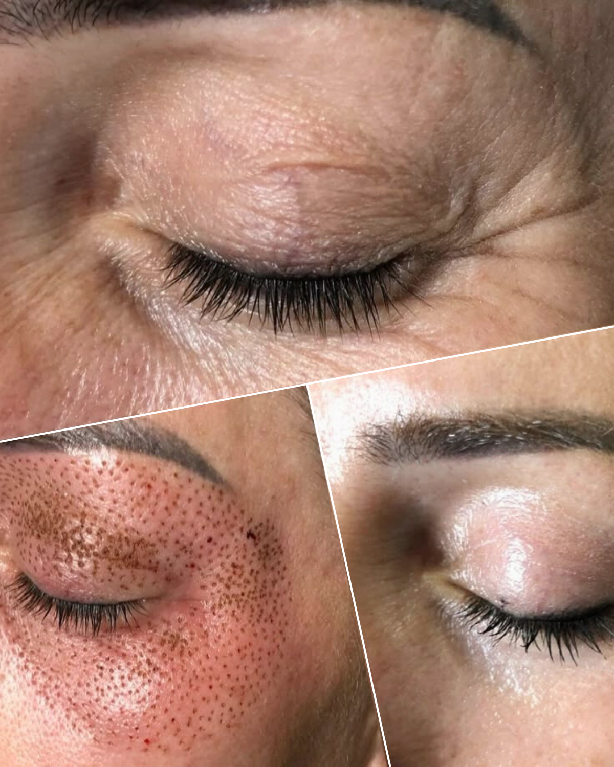 Antes Plasma Fibroblast