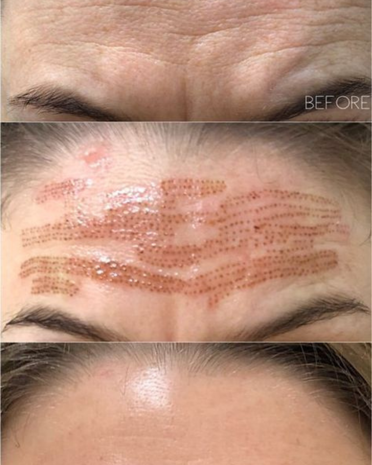 Después Plasma Fibroblast