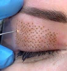 Plasma Fibroblast en Ciudad de Panamá