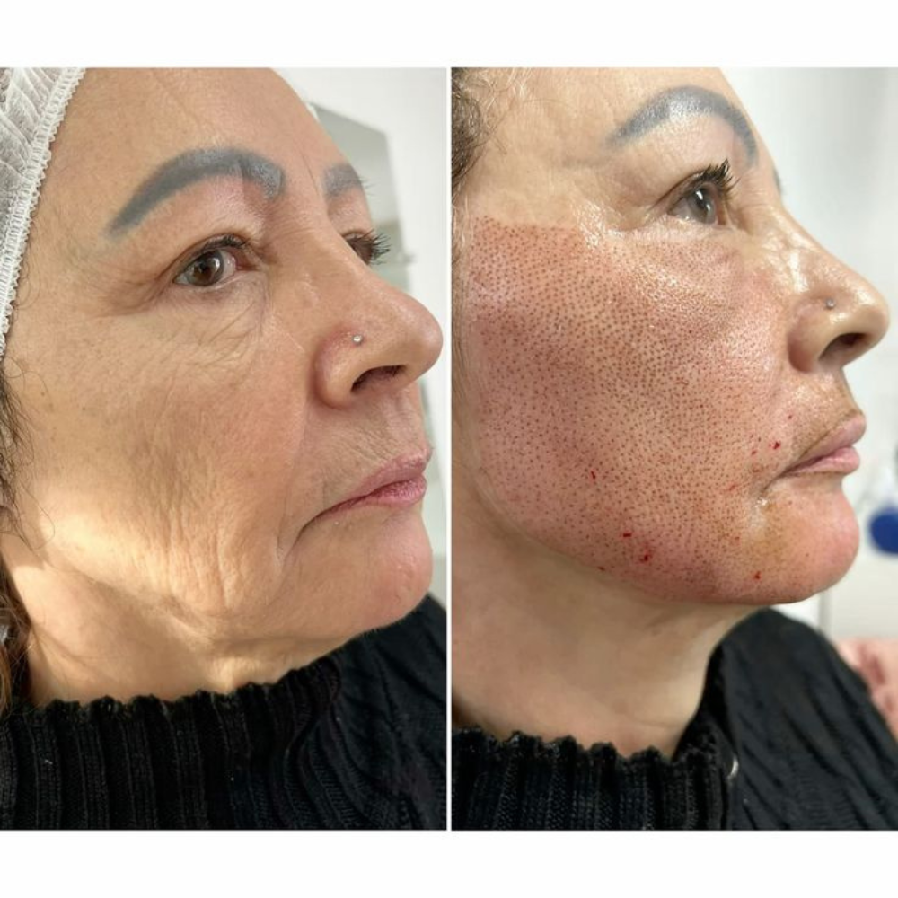 Plasma Fibroblast en párpados en Panamá