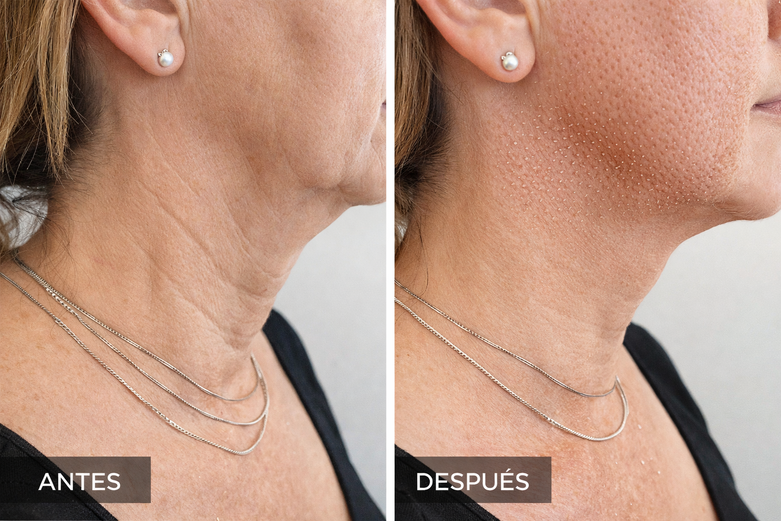 Fibroblast cuello y papada