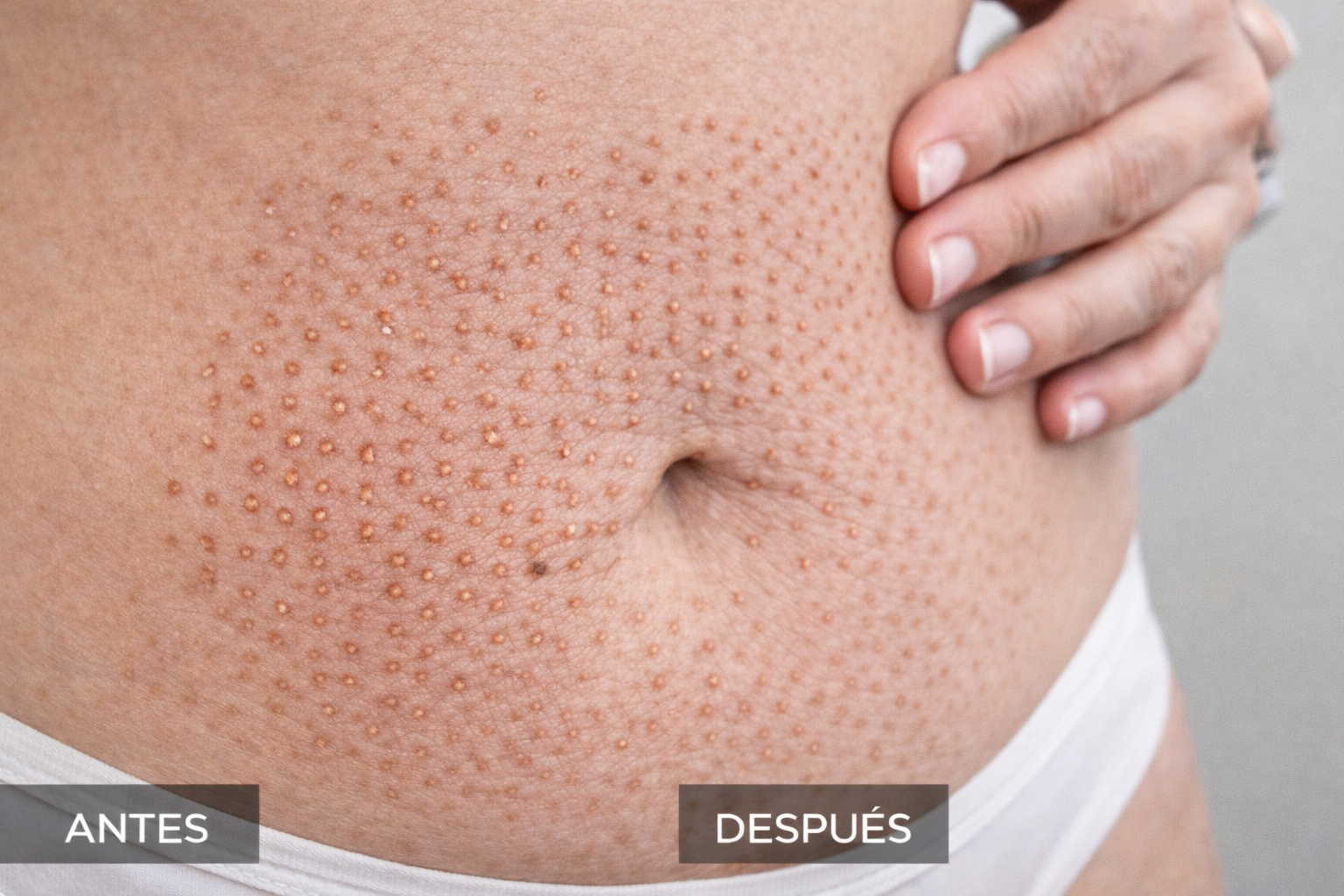 Recuperación Plasma Fibroblast