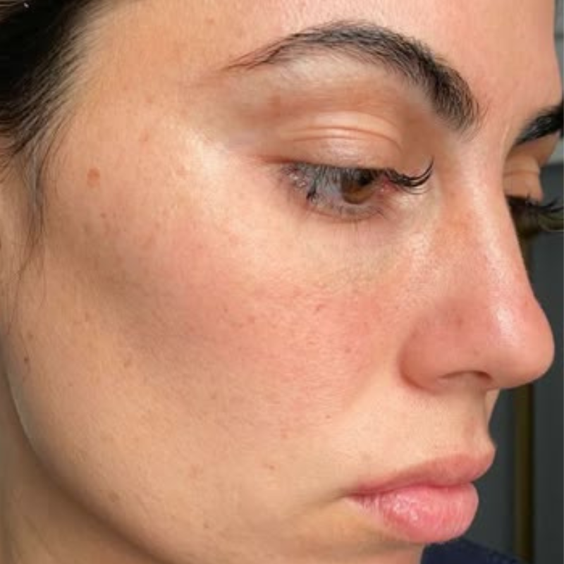 Después Peeling Facial