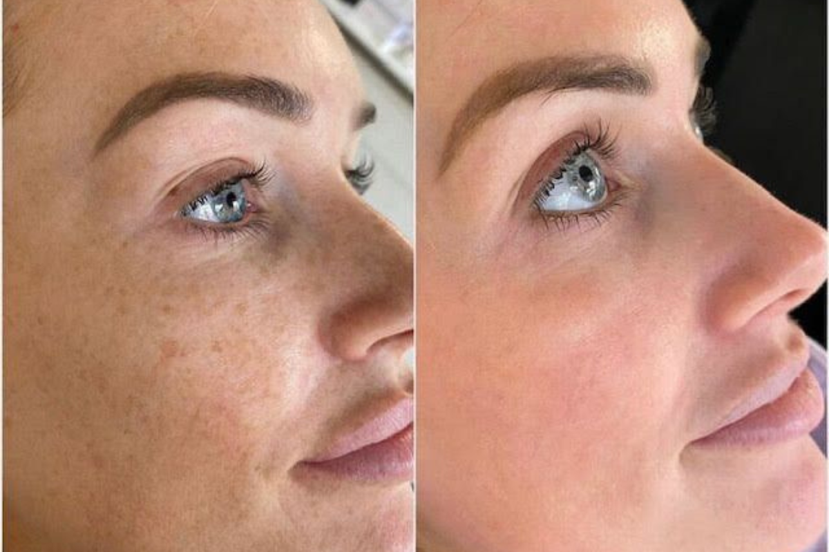 Peeling facial en Ciudad de Panamá