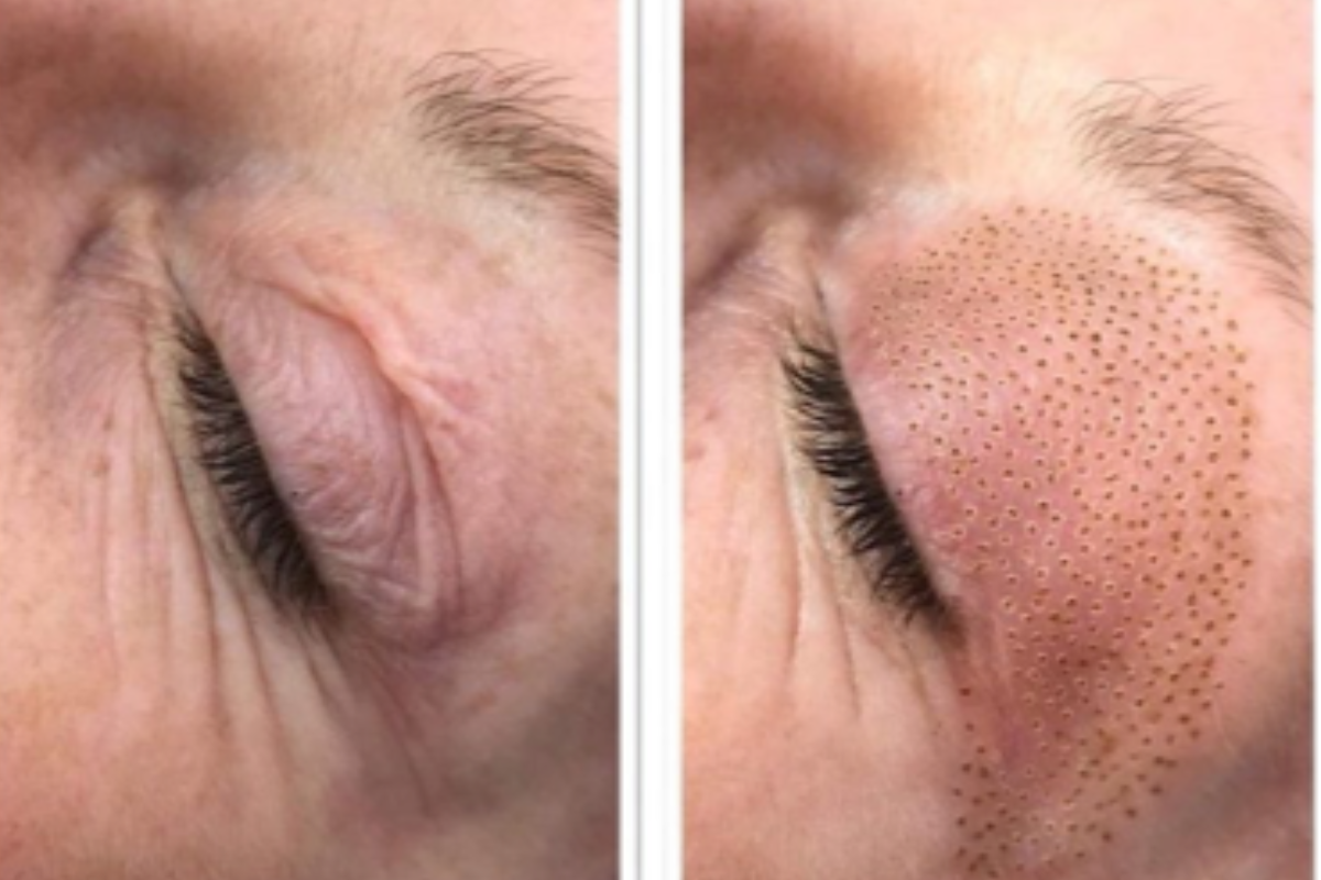 Radiofrecuencia facial en promoción