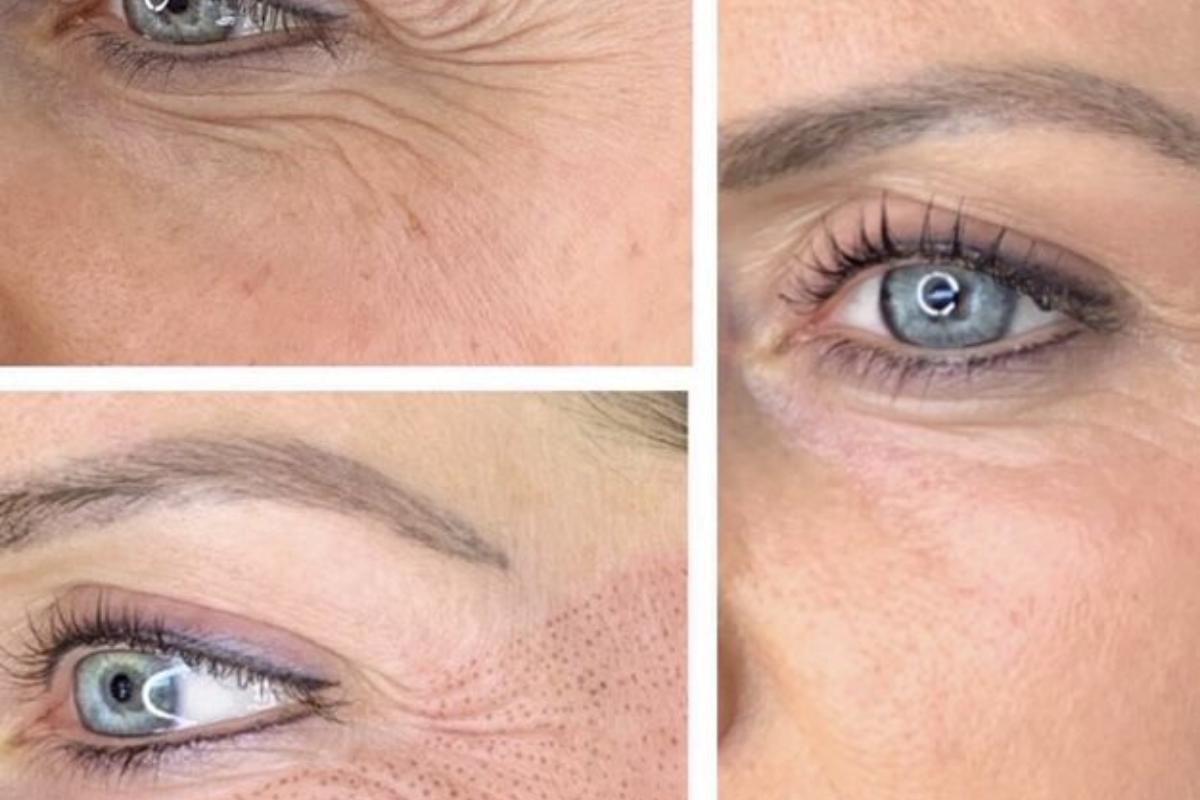 Radiofrecuencia facial en Ciudad de Panamá